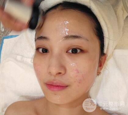 痘坑痘疤要怎么修復(fù)？果酸換膚后臉果圖和真實(shí)案例分享