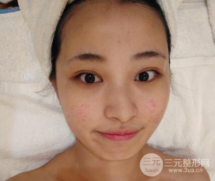 痘坑痘疤要怎么修復(fù)？果酸換膚后臉果圖和真實(shí)案例分享