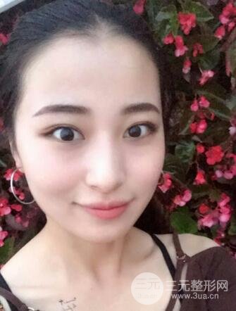 痘坑痘疤要怎么修復(fù)？果酸換膚后臉果圖和真實(shí)案例分享