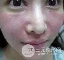 我做了光子嫩膚幾天起而且價(jià)格便宜前后對比照片案例