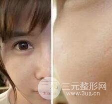我做了光子嫩膚幾天起而且價(jià)格便宜前后對比照片案例