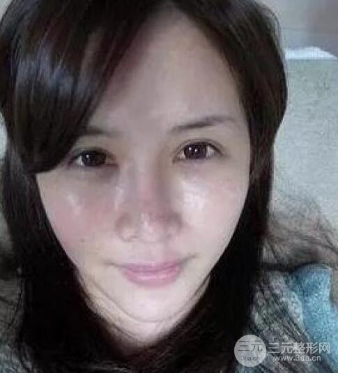 我做了光子嫩膚幾天起而且價(jià)格便宜前后對比照片案例