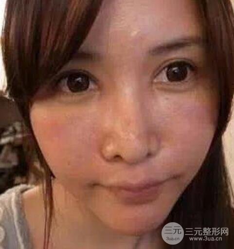 我做了光子嫩膚幾天起而且價(jià)格便宜前后對比照片案例