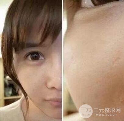 我做了光子嫩膚幾天起而且價(jià)格便宜前后對比照片案例