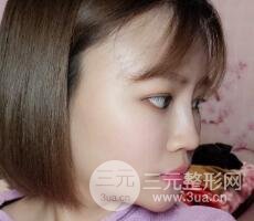 全臉脂肪填充價(jià)格 恢復(fù)過程圖 真實(shí)案例分享