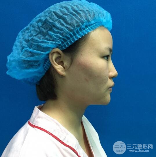 全臉脂肪填充價(jià)格 恢復(fù)過(guò)程圖 真實(shí)案例分享