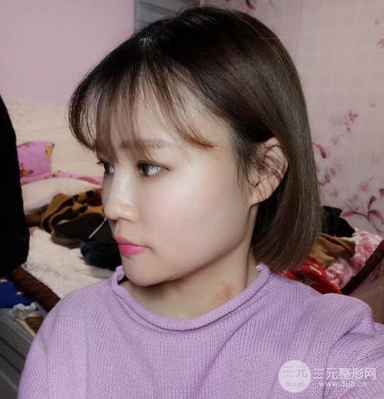 全臉脂肪填充價(jià)格 恢復(fù)過(guò)程圖 真實(shí)案例分享