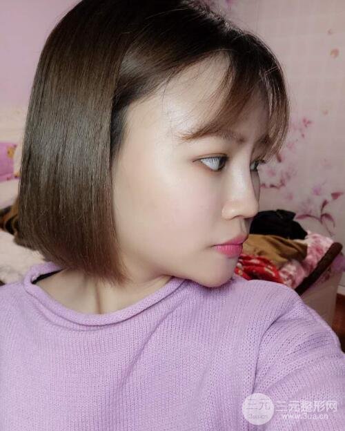 全臉脂肪填充價(jià)格 恢復(fù)過(guò)程圖 真實(shí)案例分享