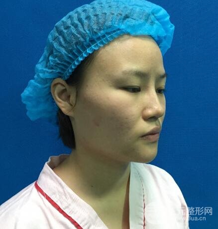 全臉脂肪填充價(jià)格 恢復(fù)過(guò)程圖 真實(shí)案例分享