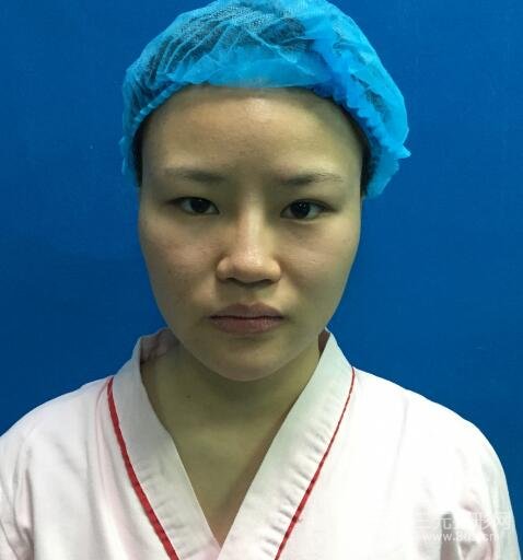 全臉脂肪填充價(jià)格 恢復(fù)過(guò)程圖 真實(shí)案例分享