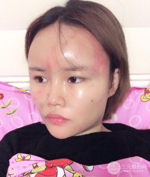全臉脂肪填充價(jià)格 恢復(fù)過(guò)程圖 真實(shí)案例分享