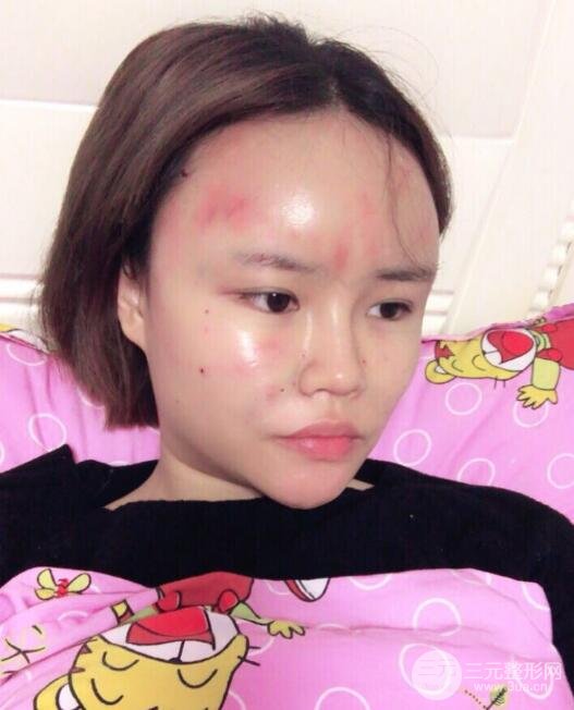 全臉脂肪填充價(jià)格 恢復(fù)過(guò)程圖 真實(shí)案例分享