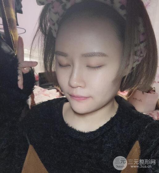 全臉脂肪填充價(jià)格 恢復(fù)過(guò)程圖 真實(shí)案例分享