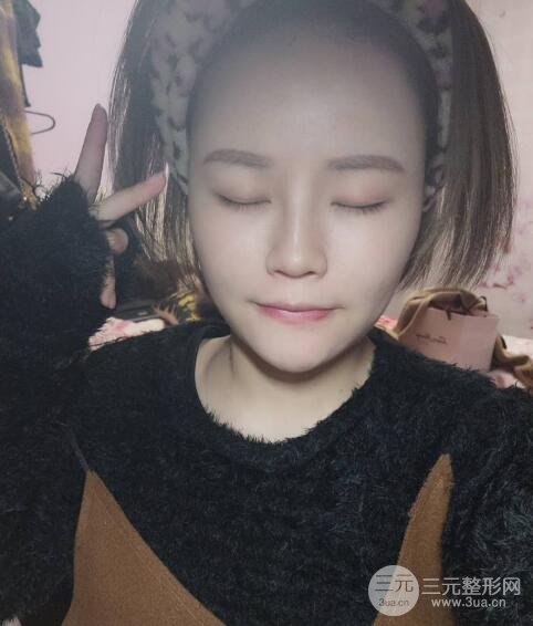 全臉脂肪填充價(jià)格 恢復(fù)過(guò)程圖 真實(shí)案例分享