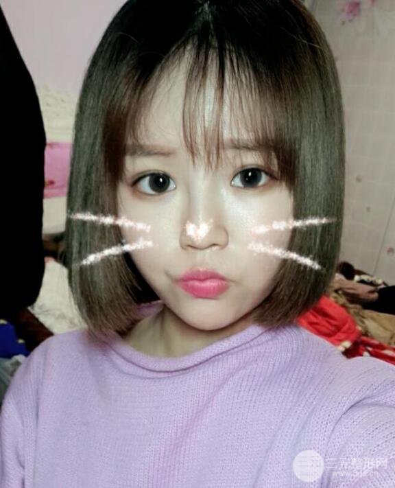 全臉脂肪填充價(jià)格 恢復(fù)過(guò)程圖 真實(shí)案例分享