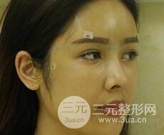 大腿抽脂做臉部脂肪填充 包括太陽穴和額頭價(jià)格果分享