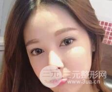 大腿抽脂做臉部脂肪填充 包括太陽穴和額頭價(jià)格果分享