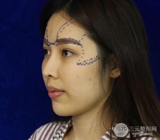 大腿抽脂做臉部脂肪填充 包括太陽穴和額頭價格果分享