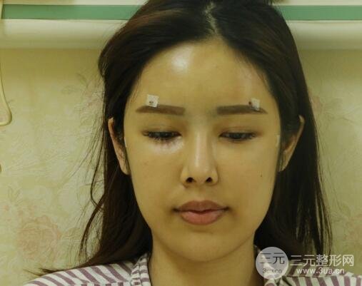 大腿抽脂做臉部脂肪填充 包括太陽穴和額頭價格果分享