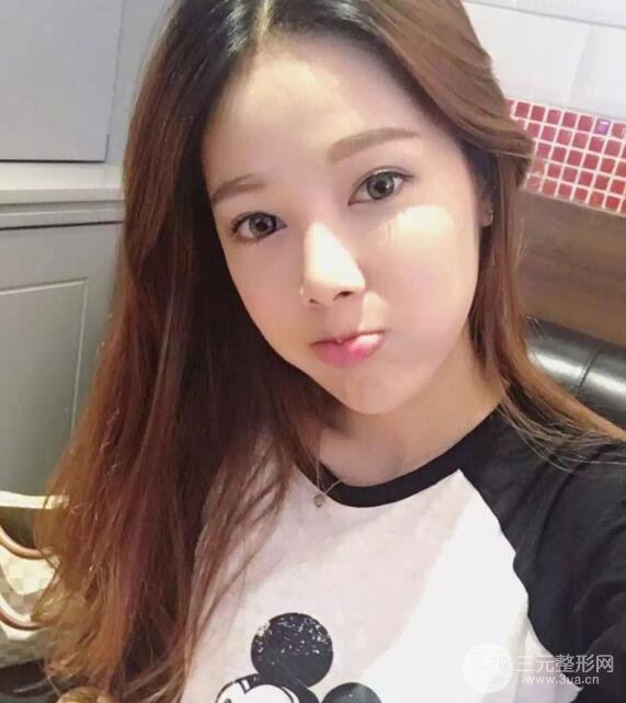 大腿抽脂做臉部脂肪填充 包括太陽穴和額頭價格果分享