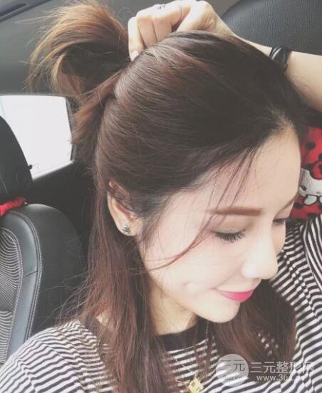 大腿抽脂做臉部脂肪填充 包括太陽穴和額頭價格果分享