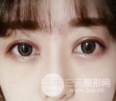 腫泡眼單眼皮變雙眼皮真實切開雙眼皮案例和對比圖