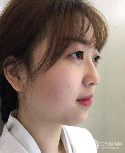 腫泡眼單眼皮變雙眼皮真實(shí)切開雙眼皮案例和對(duì)比圖