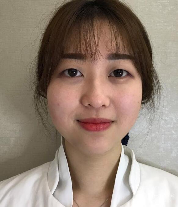 腫泡眼單眼皮變雙眼皮真實(shí)切開雙眼皮案例和對(duì)比圖