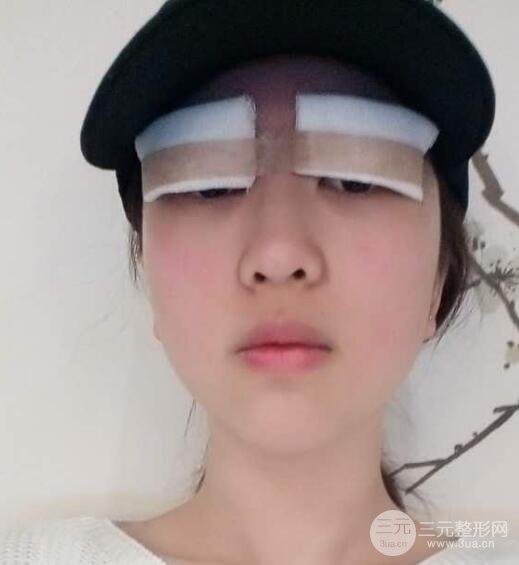 腫泡眼單眼皮變雙眼皮真實(shí)切開雙眼皮案例和對(duì)比圖