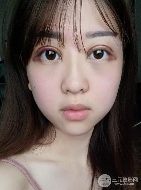 腫泡眼單眼皮變雙眼皮真實(shí)切開雙眼皮案例和對(duì)比圖