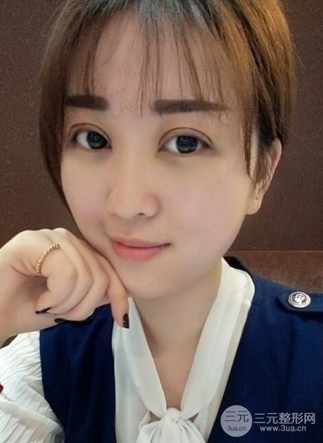 腫泡眼單眼皮變雙眼皮真實(shí)切開雙眼皮案例和對(duì)比圖