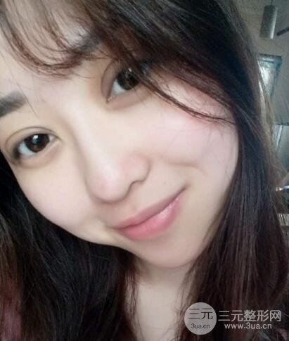 腫泡眼單眼皮變雙眼皮真實(shí)切開雙眼皮案例和對(duì)比圖