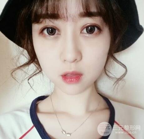 腫泡眼單眼皮變雙眼皮真實(shí)切開雙眼皮案例和對(duì)比圖