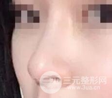 鼻子整形之駝峰鼻矯正價(jià)格和前后對(duì)比圖 真人案例