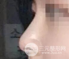 鼻子整形之駝峰鼻矯正價(jià)格和前后對(duì)比圖 真人案例