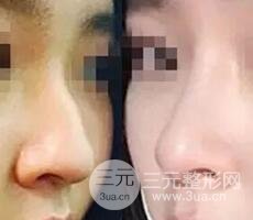 鼻子整形之駝峰鼻矯正價(jià)格和前后對(duì)比圖 真人案例