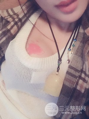 珠海萊茵門診部盧剛醫(yī)生假體隆胸真實(shí)案例，還有前后對比照片喲