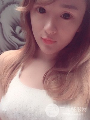 珠海萊茵門診部盧剛醫(yī)生假體隆胸真實(shí)案例，還有前后對比照片喲