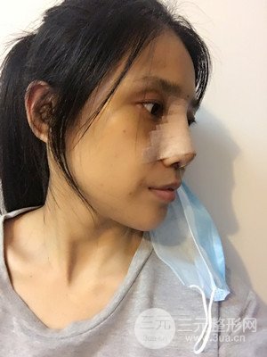 珠海萊茵門診部馬中衛(wèi)隆鼻整形案例分享，并附上前后對(duì)比照片~