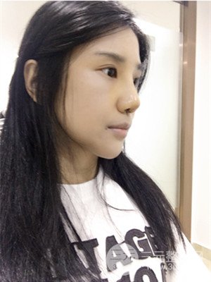 珠海萊茵門診部馬中衛(wèi)隆鼻整形案例分享，并附上前后對(duì)比照片~