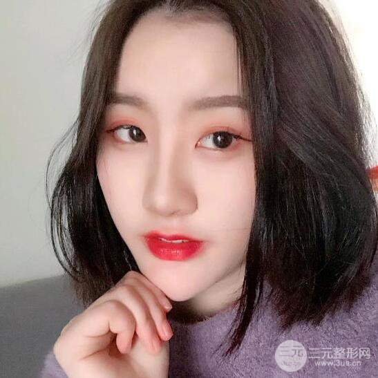 膨體隆鼻三十天恢復(fù)記錄，術(shù)前術(shù)后對比圖片曝光