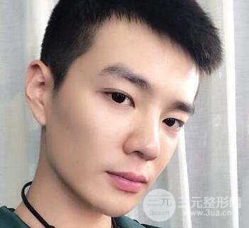 高強(qiáng)度聚焦超聲面b提升術(shù)多少錢?親身經(jīng)歷案例