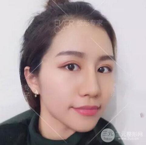 割歐式雙眼皮價(jià)格和案例