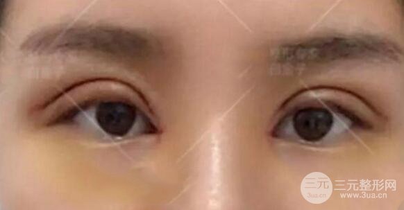 割歐式雙眼皮價(jià)格和案例