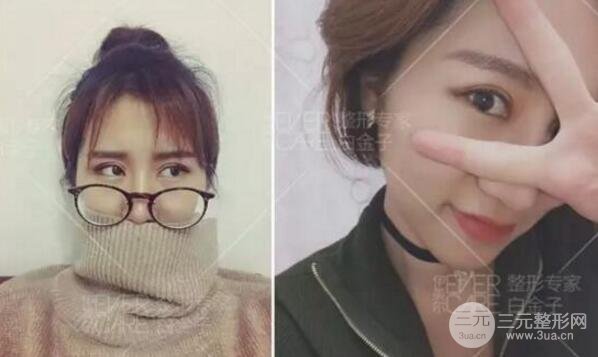 割歐式雙眼皮價(jià)格和案例