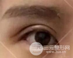 割歐式雙眼皮價格和案例