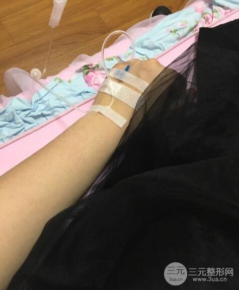 隆鼻整形包括假體隆鼻+耳軟骨墊鼻尖+鼻小柱延長