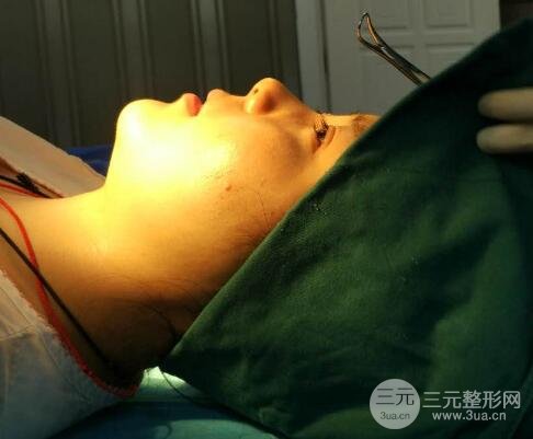 隆鼻整形包括假體隆鼻+耳軟骨墊鼻尖+鼻小柱延長