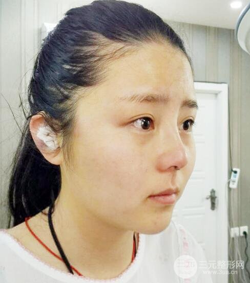 隆鼻整形包括假體隆鼻+耳軟骨墊鼻尖+鼻小柱延長