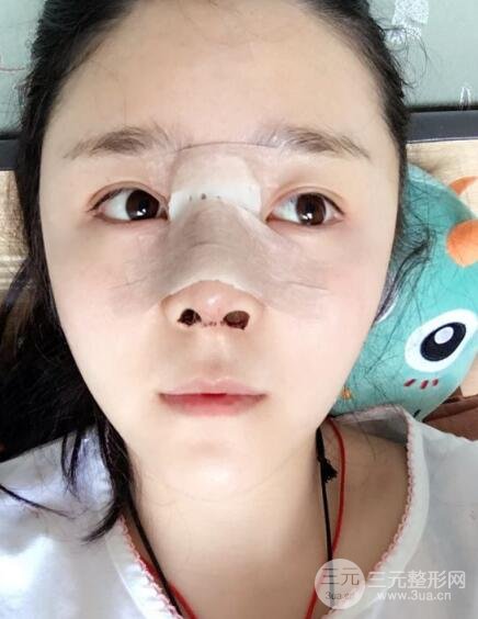 隆鼻整形包括假體隆鼻+耳軟骨墊鼻尖+鼻小柱延長